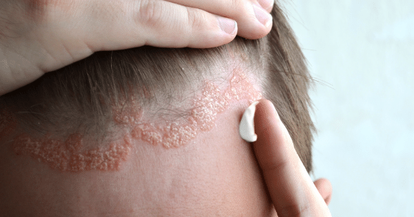 Seboroická dermatitída